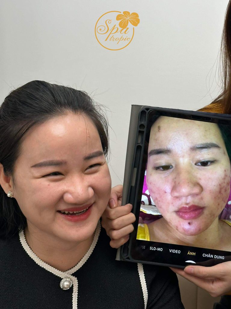 điều trị mụn viêm