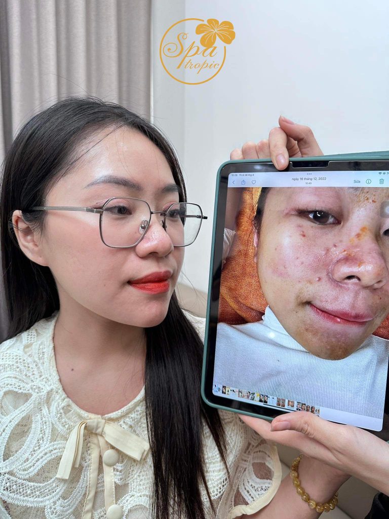 điều trị mụn viêm tại spa tropic