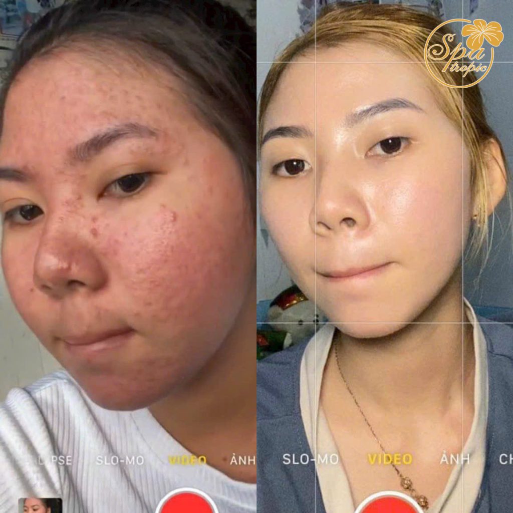 điều trị mụn hiệu quả tại spa tropic