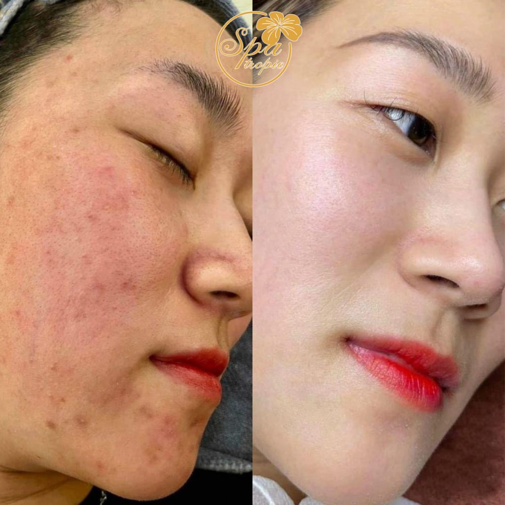 hiệu quả điều trị mụn viêm tại spa tropic