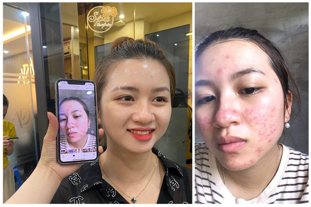 trị mụn viêm hiệu quả tại Spa Tropic