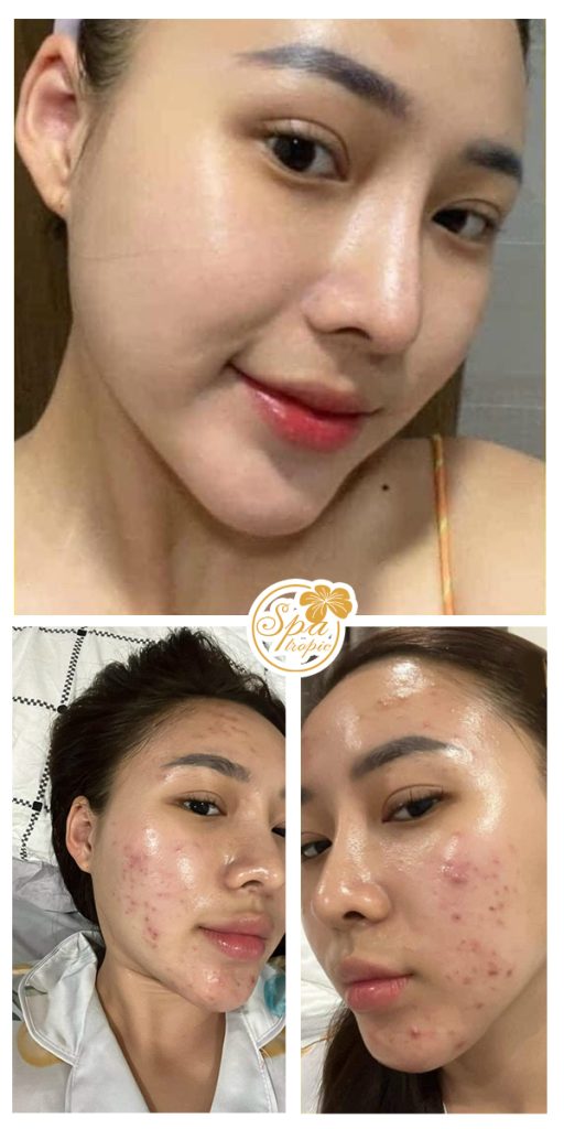 điều trị mụn hiệu quả tại Spa Tropic